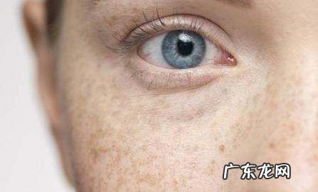 黄褐斑和雀斑的区别,雀斑黄褐斑怎么区分