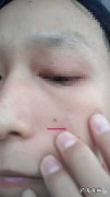 挤完痘痘留下的黑印怎么去除,脸上留下的红色痘印怎么去除