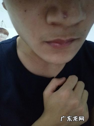 挤完痘痘留下的黑印怎么去除,脸上留下的红色痘印怎么去除