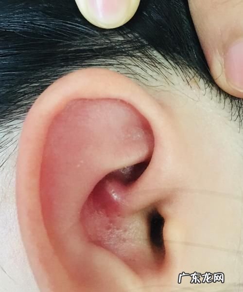 耳朵长痘痘是什么原因,耳朵里长了一个痘痘是怎么回事